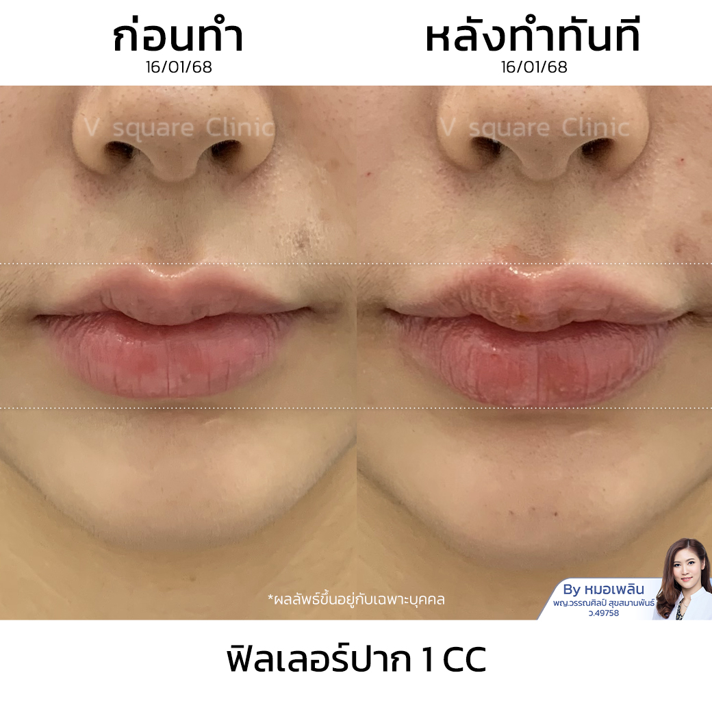 รีวิวฉีดฟิลเลอร์ปาก 1 CC ที่ V Square Clinic (6)