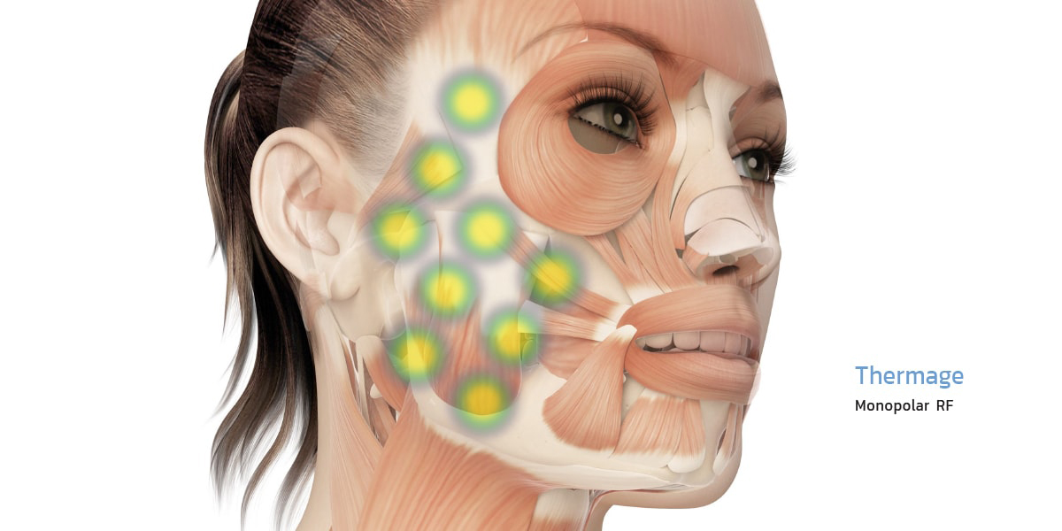 Thermage ยกกระชับผิว