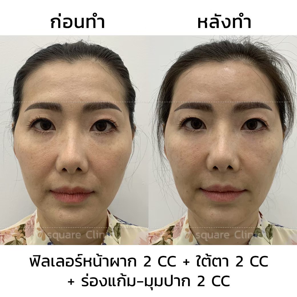 ฉีดฟิลเลอร์ยกมุมปาก