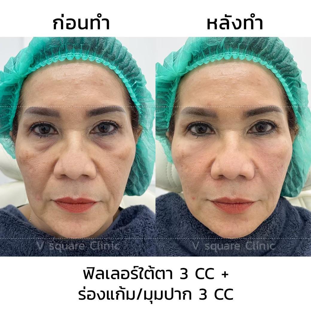 ฉีดฟิลเลอร์ยกมุมปาก(1)