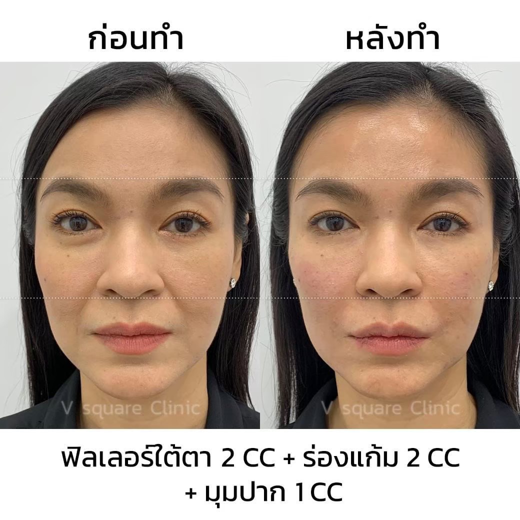 ฉีดฟิลเลอร์ยกมุมปาก(2)