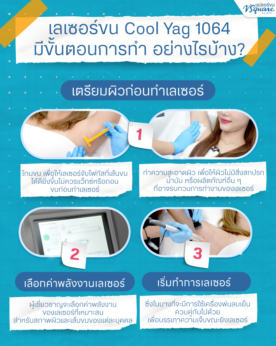 ขั้นตอนการทำเลเซอร์ขน