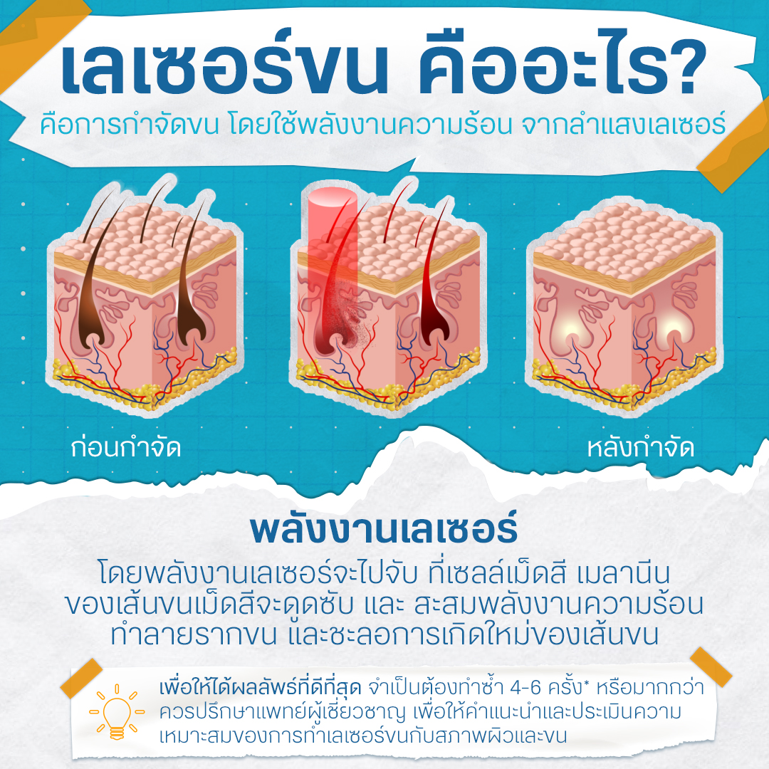 เลเซอร์ขน คืออะไร