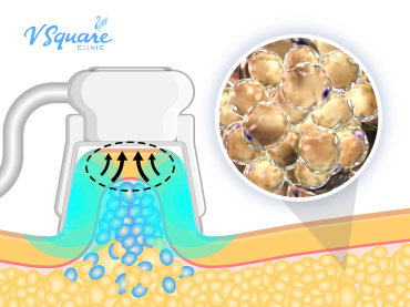 รูปบทความ_coolsculpting-คืออะไร-ทำไมต้องกำจัดไขมัน_