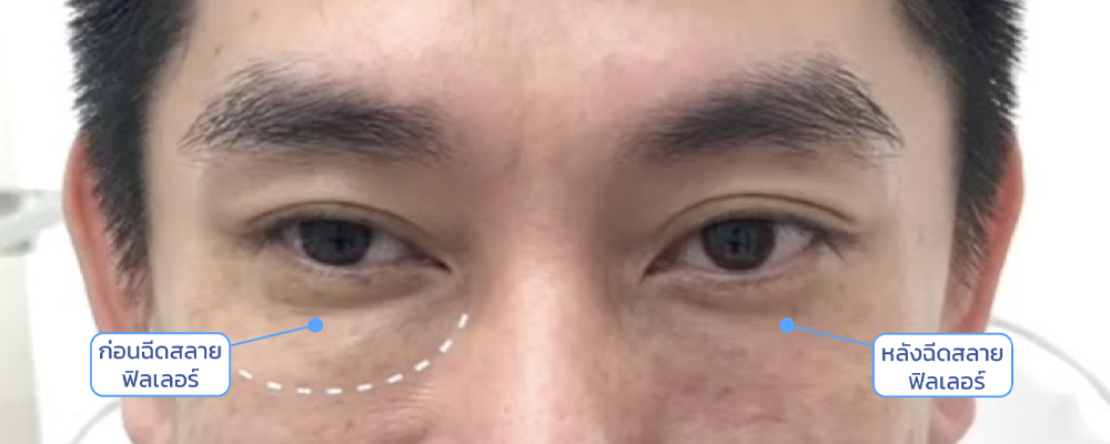 ฉีดสลายฟิลเลอร์กี่วันเห็นผล