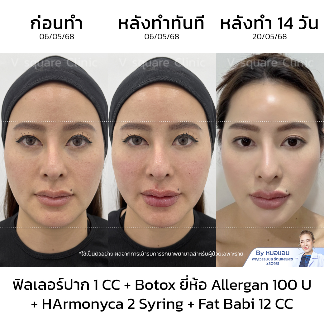 ฉีดเมโสแฟตหน้า รีวิว_ส้ม