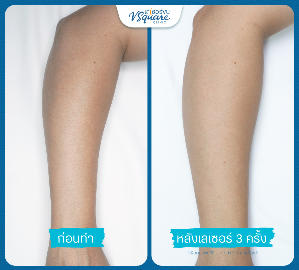 รีวิว Laser ขนแขน
