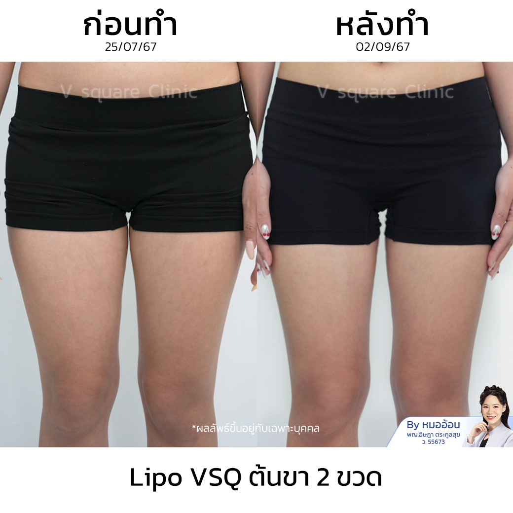 รีวิวเมโสแฟตต้นขา_คุณแคท Influencer (Lipo V)