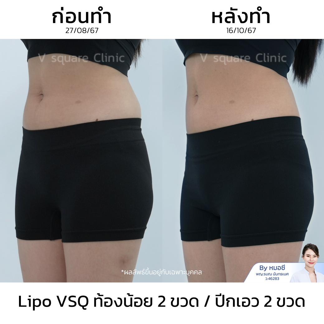 รีวิวเมโสแฟตหน้าท้อง_คุณปาล์ม Influencer (Lipo V)