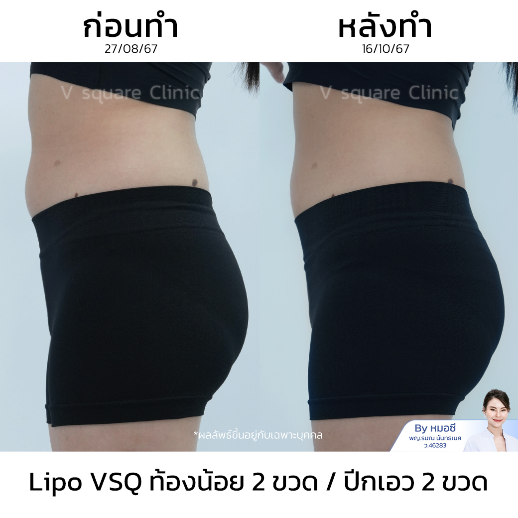 รีวิวเมโสแฟตหน้าท้อง_คุณปาล์ม Influencer (Lipo V)(1)