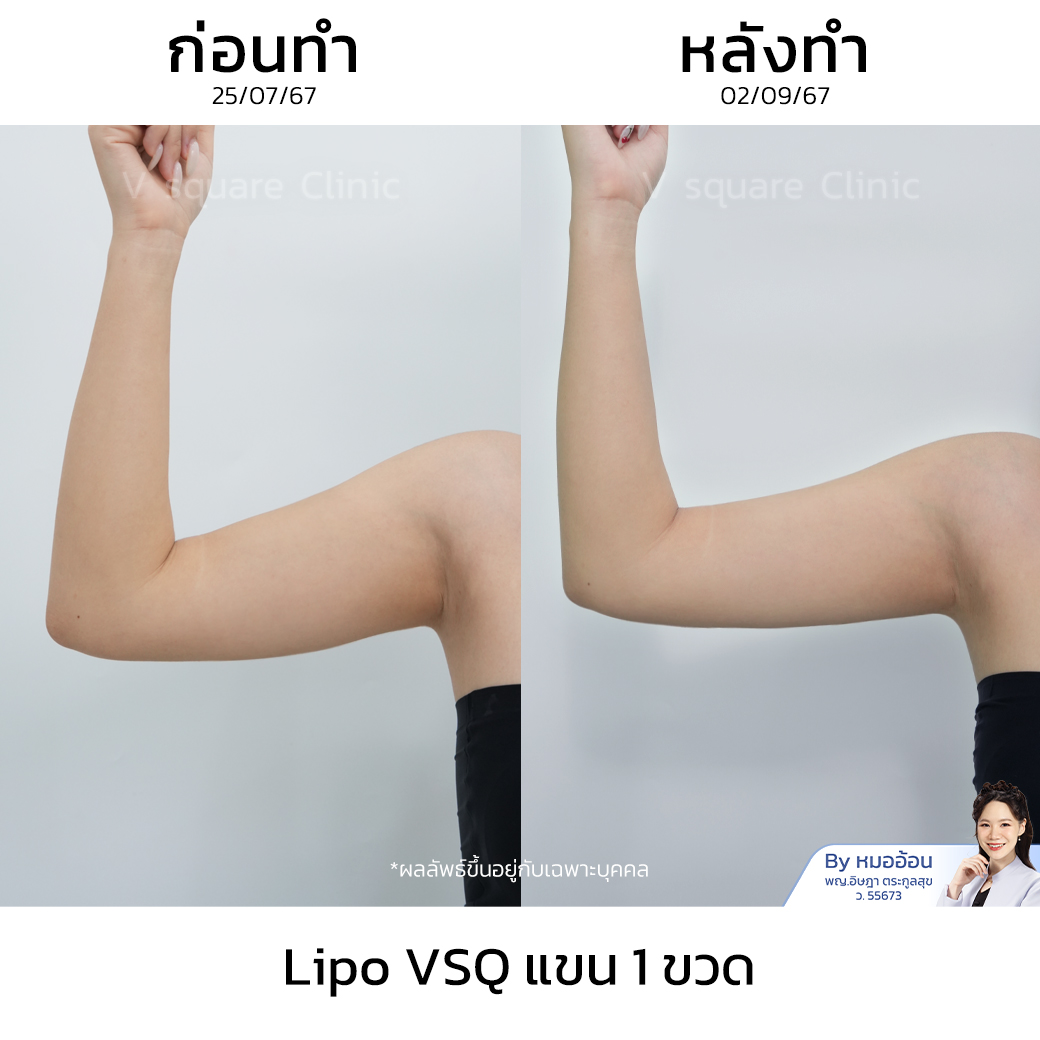 รีวิวเมโสแฟตแขน_คุณแคท Influencer (Lipo V)