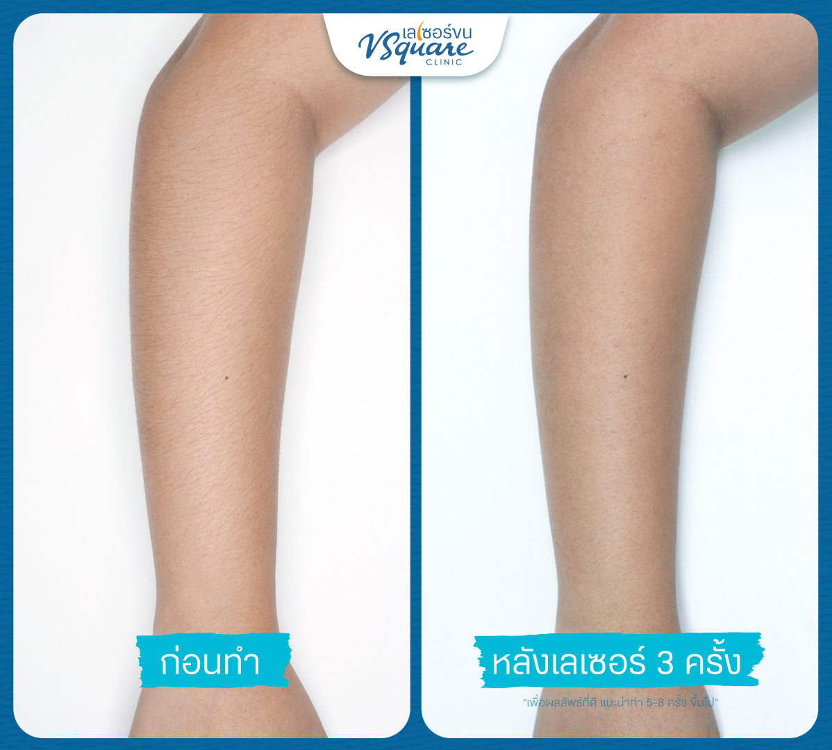 รีวิวเลเซอร์ขนแขน