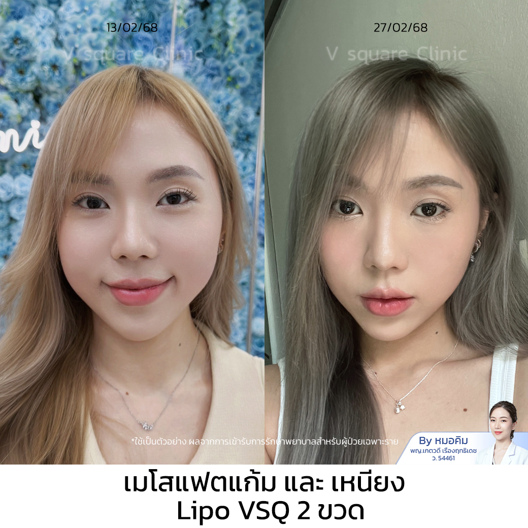 เมโสแฟตแก้ม เหนียง รีวิว_มิ้น