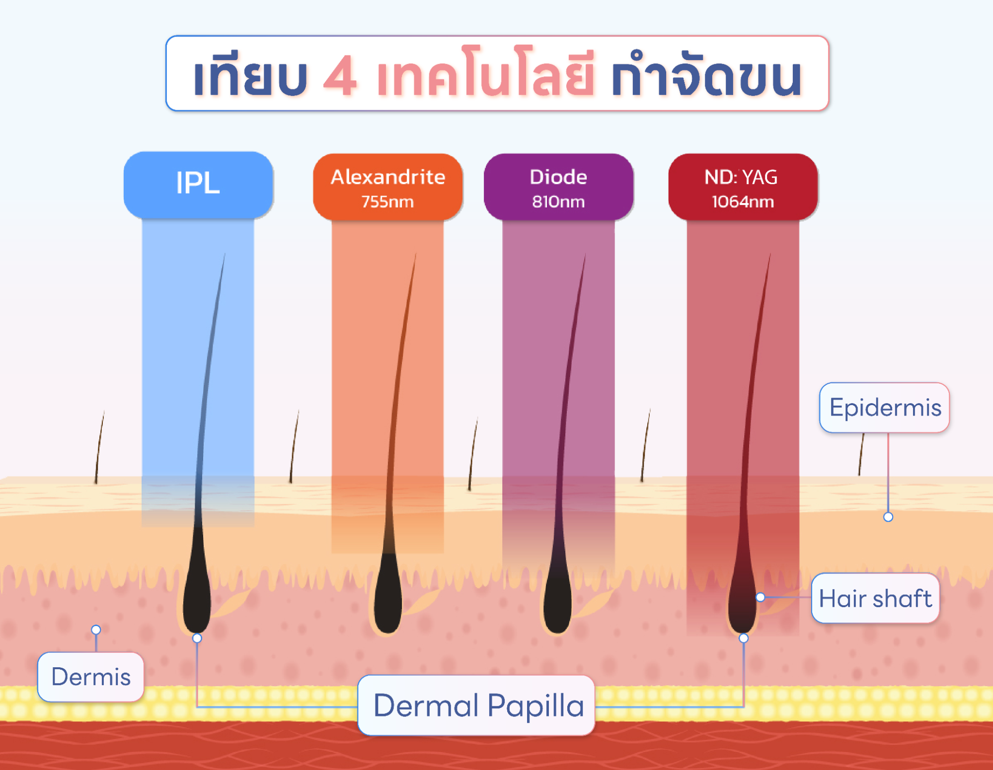 เลเซอร์หนวด ใช้เครื่องเลเซอร์แบบไหนดี