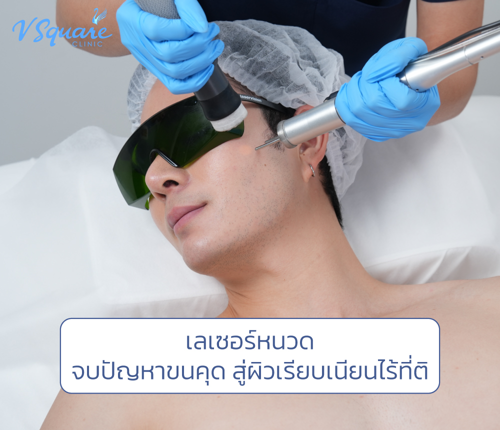 เลเซอร์หนวด