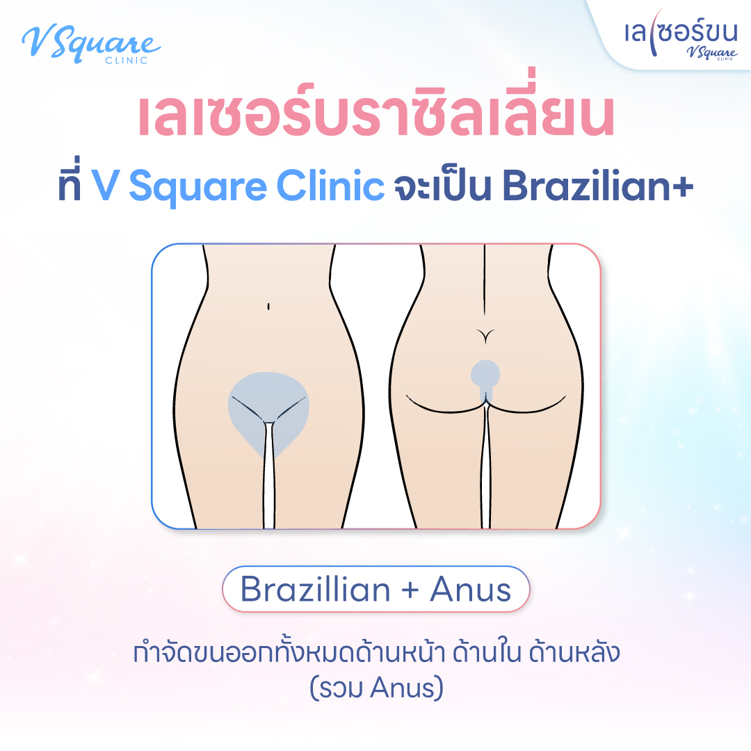 Brazilian Laser