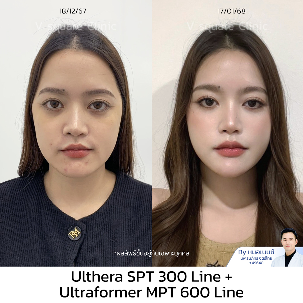 รีวิว Ulthera_คุณเฟรนด์ UL SPT+MPT