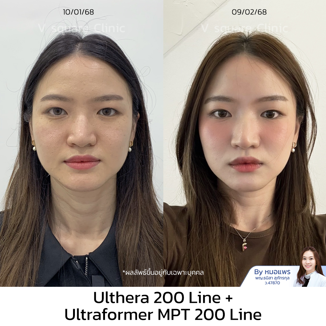 รีวิว Ulthera_ฟิว