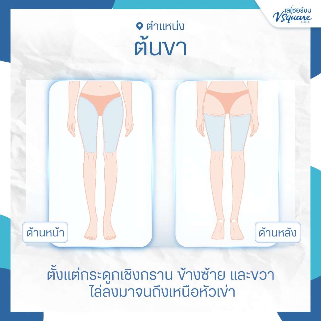 ตำแหน่งเลเซอร์ขนขาบน