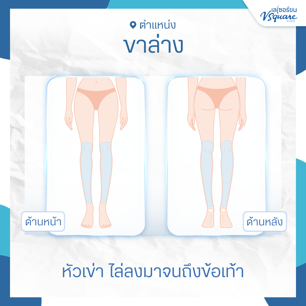 ตำแหน่งเลเซอร์ขนขาล่าง
