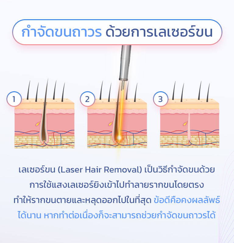 เลเซอร์ขนถาวร