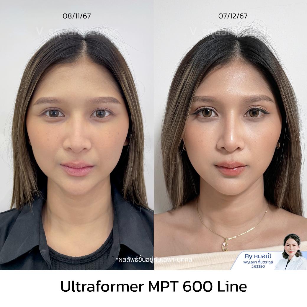 Ultraformer MPT รีวิว