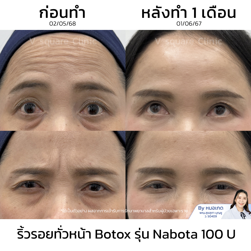 ฉีดโบท็อก_คุณเนตร