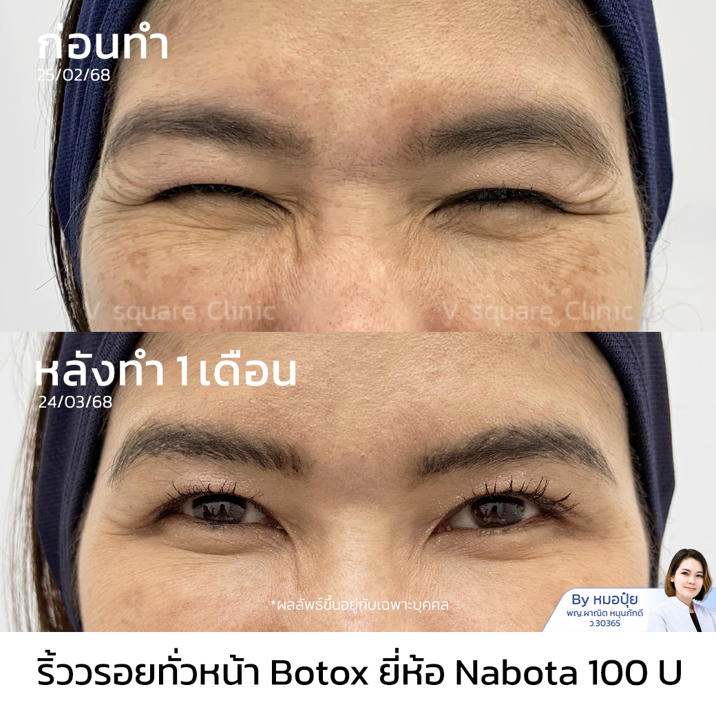 ฉีดโบท็อกลดริ้วรอยตีนกา_คุณหมวย