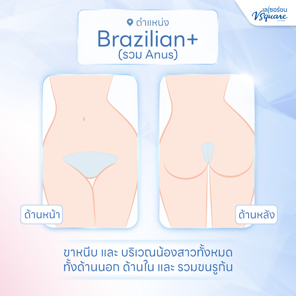 ตำแหน่งเลเซอร์ Bikini
