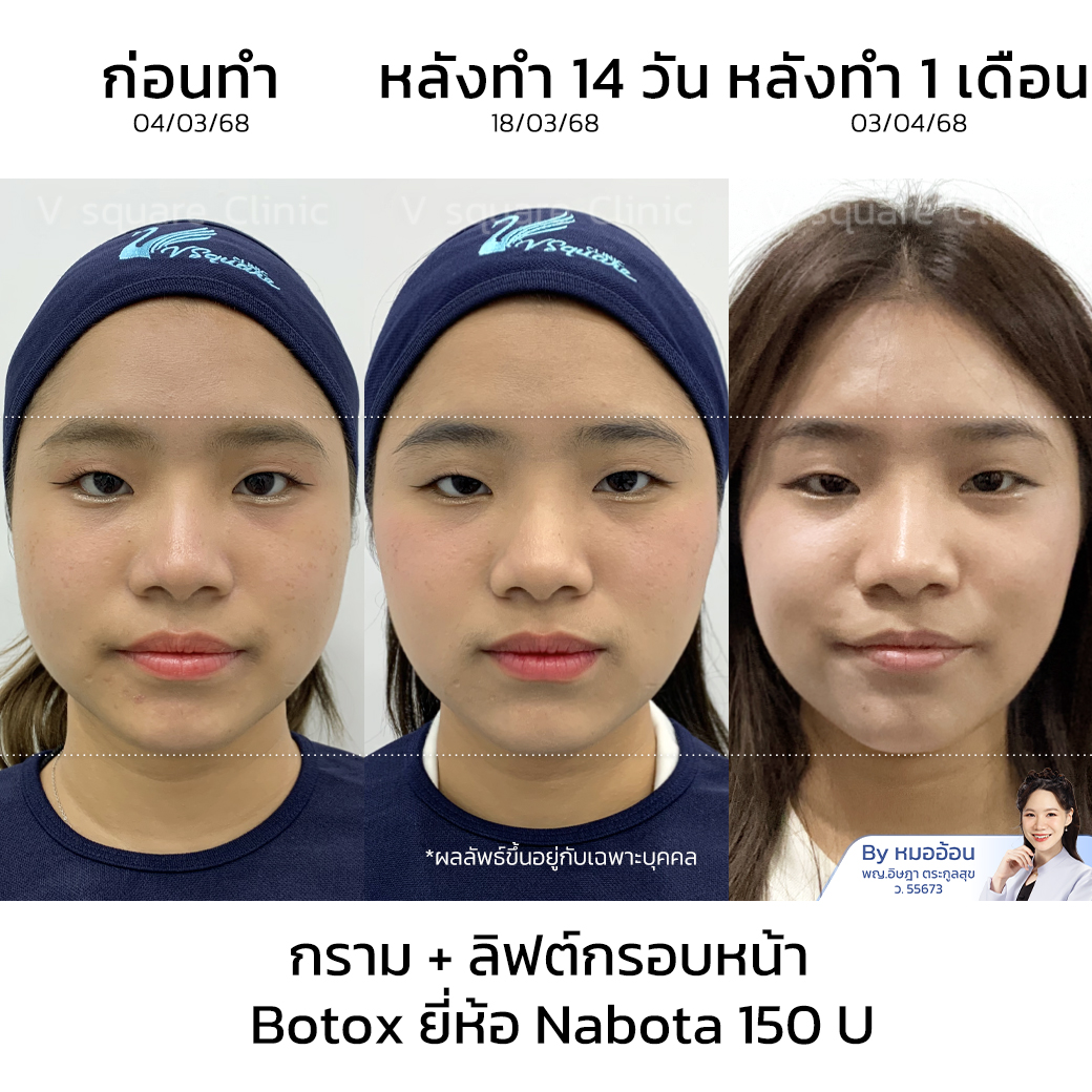 รีวิวฉีดโบท็อกลดกราม ปรับหน้าเรียว_คุณนิ้งค์