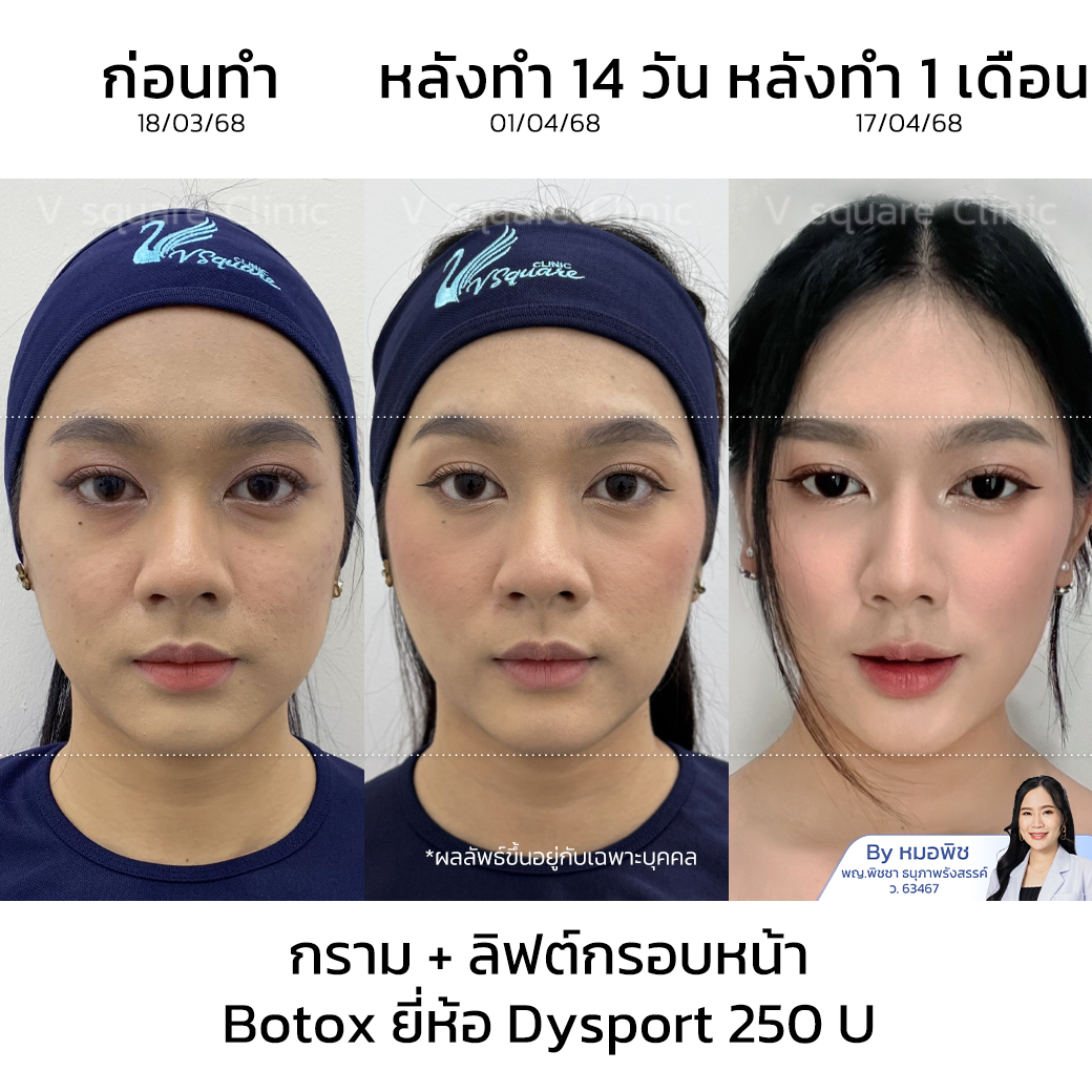 รีวิวฉีดโบท็อกลดกราม ลิฟกรอบหน้า_คุณยาหยี