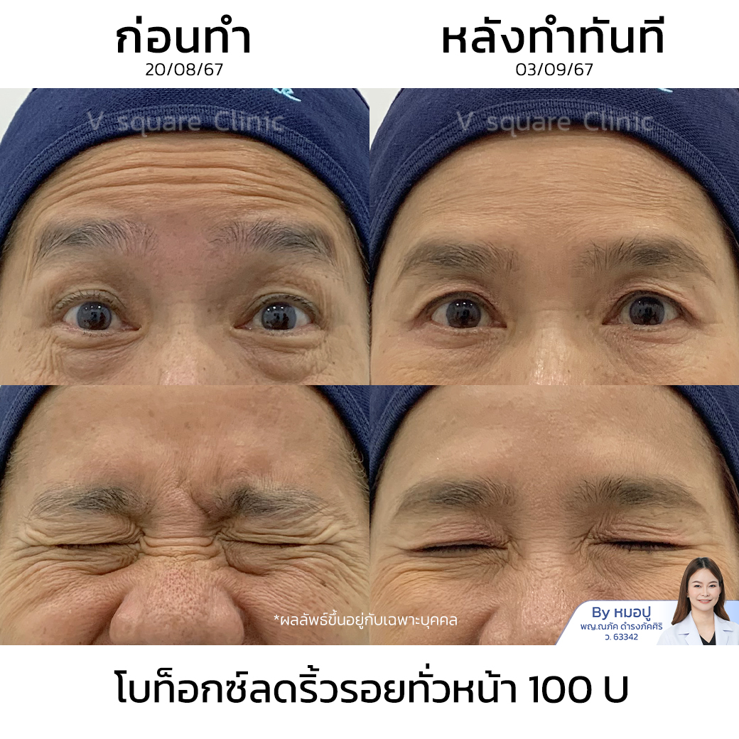 รีวิวฉีดโบท็อกลดริ้วรอย_คุณชมพู่