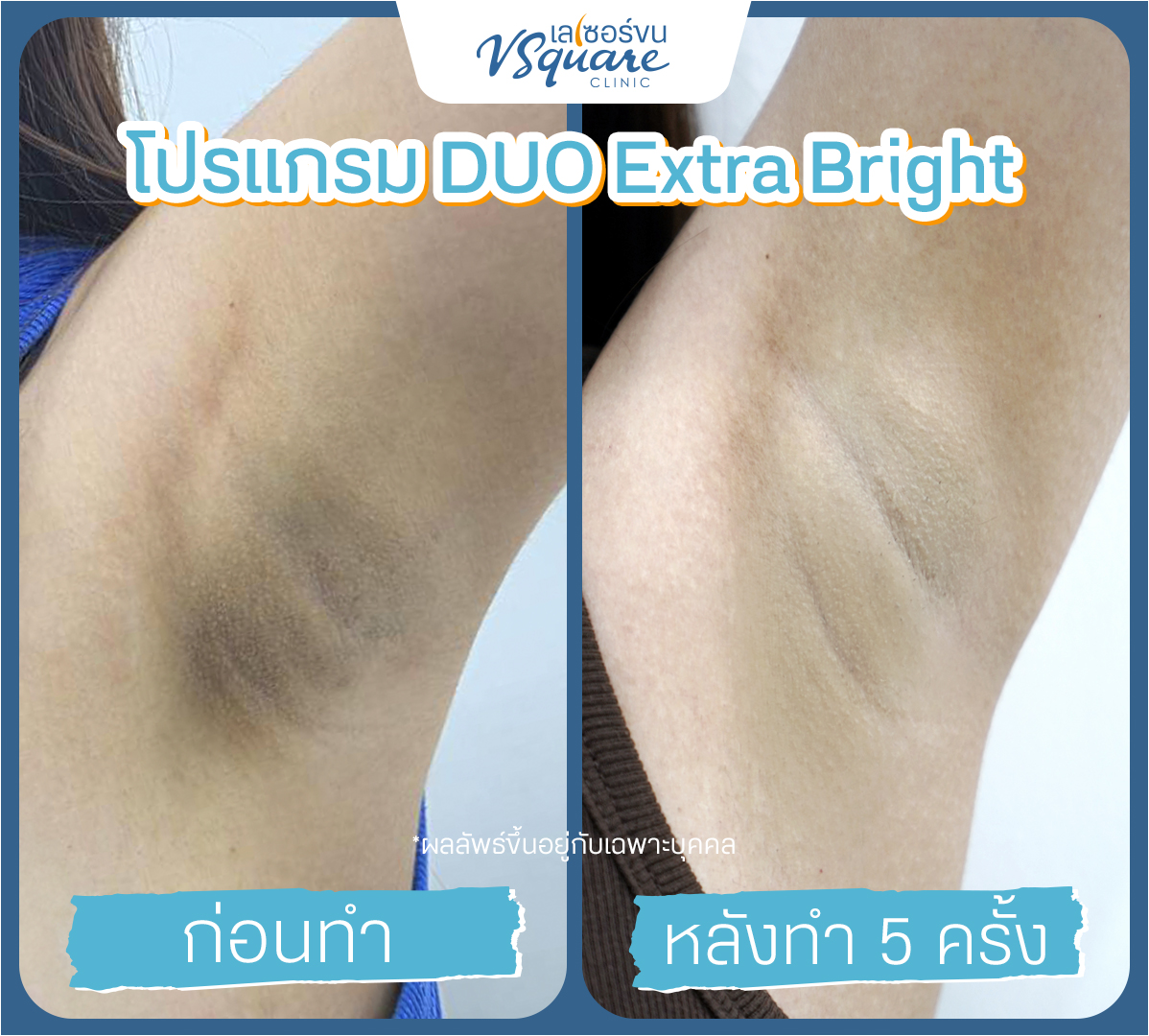 รีวิวผลลัพธ์ Yag Reju Duo Extra Bright ก่อนทำ-หลังทำ
