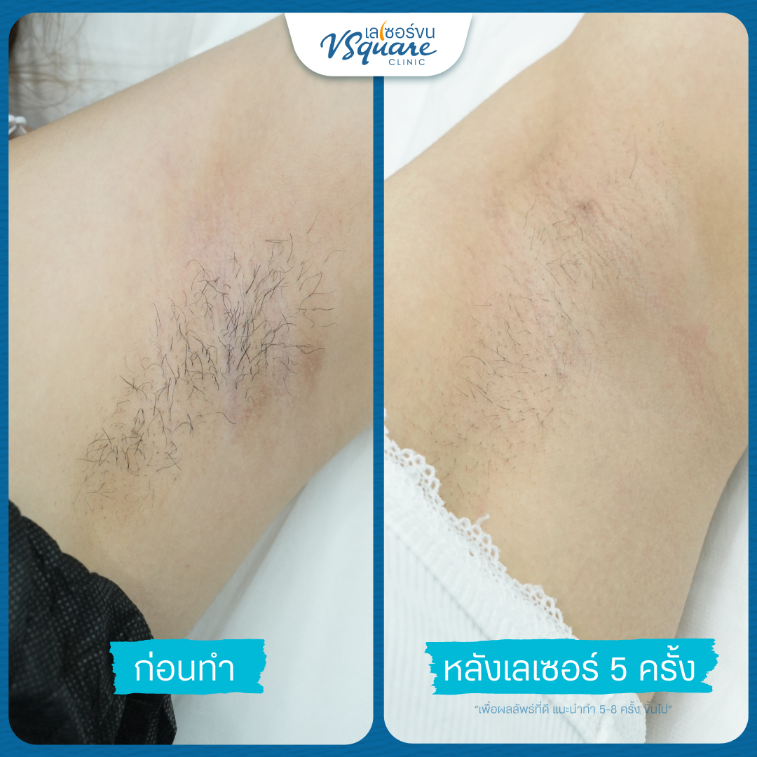 รีวิวเลเซอร์ขนรักแร้