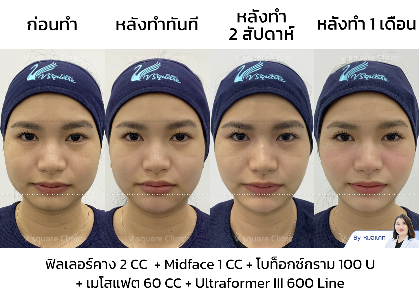 รีวิวโบท็อก ร่วมกับหัตถการอื่น_คุณเนย_Influencer_(คอนเทนต์หน้าเรียว)
