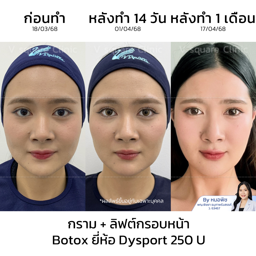 รีวิวโบท็อกลดกราม_คุณฟ้า