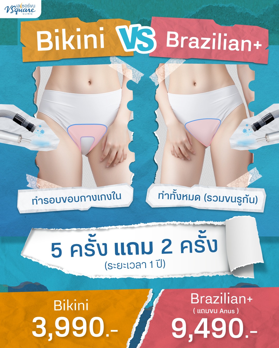 เปรียบเทียบเลเซอร์บิกินี่กับเลเซอร์บราซิลเลี่ยน