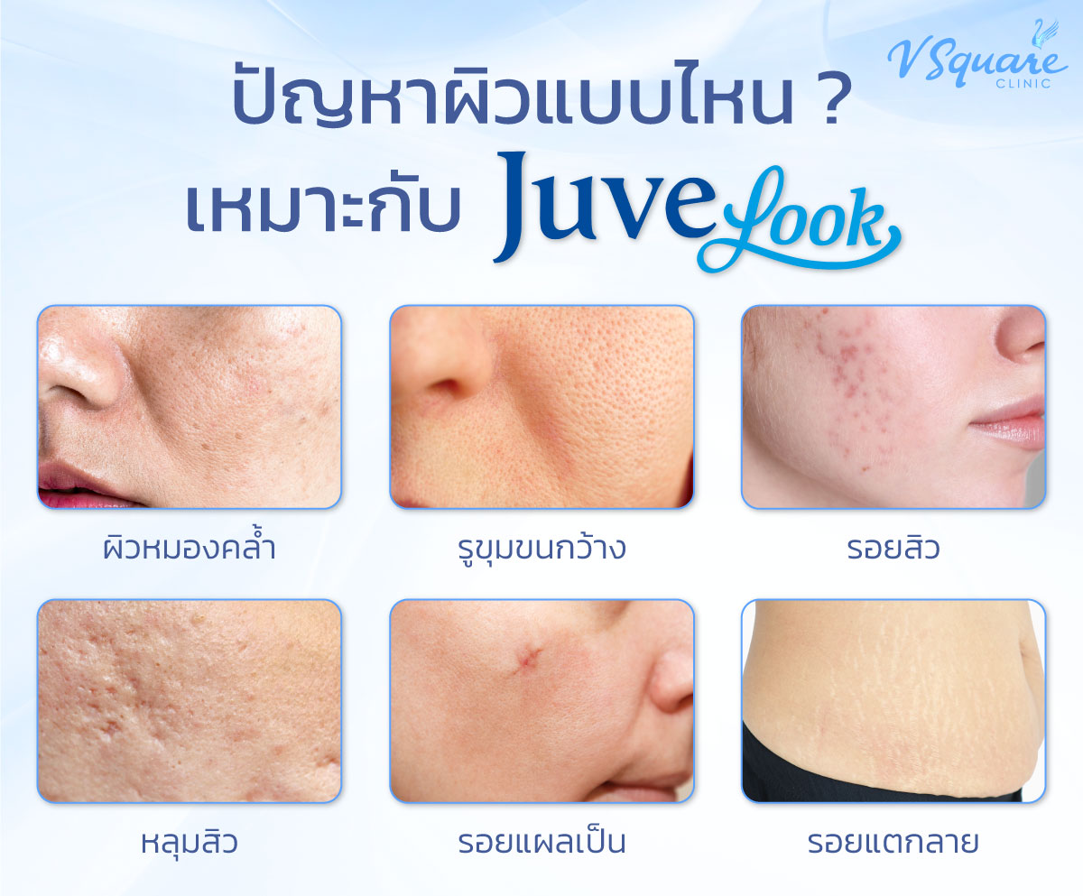 Juvelook เหมาะกับใคร