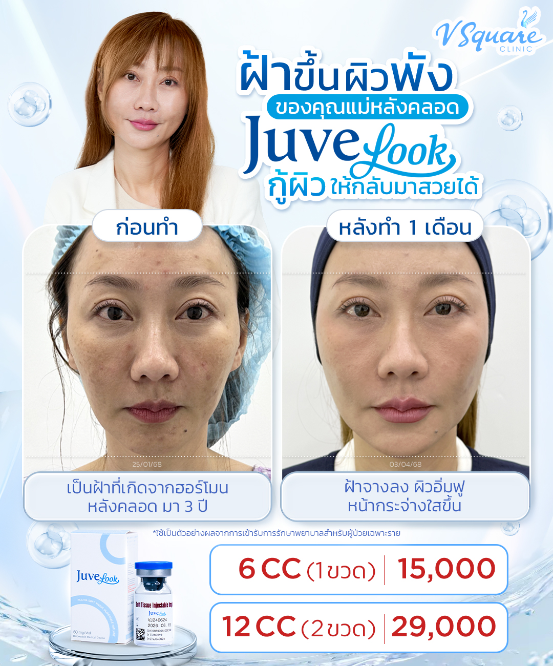 รีวิว Juvelook