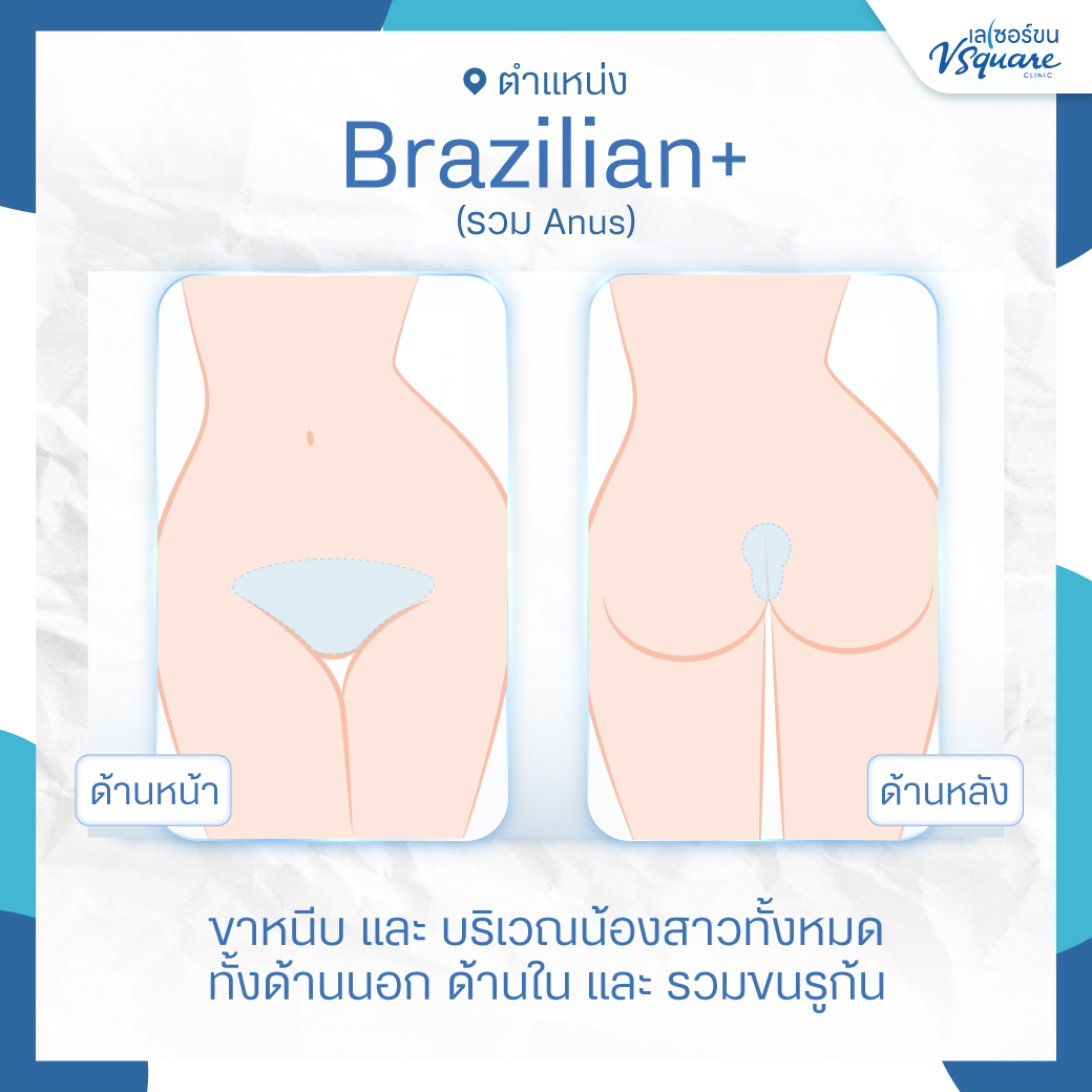 เลเซอร์บราซิลเลี่ยน