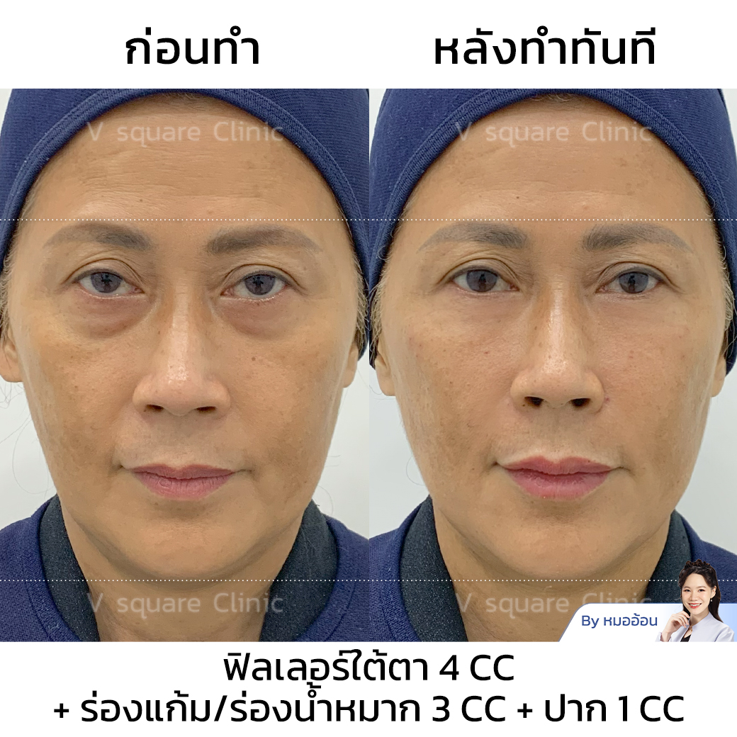 ฉีดฟิลเลอร์เกาหลี รีวิว