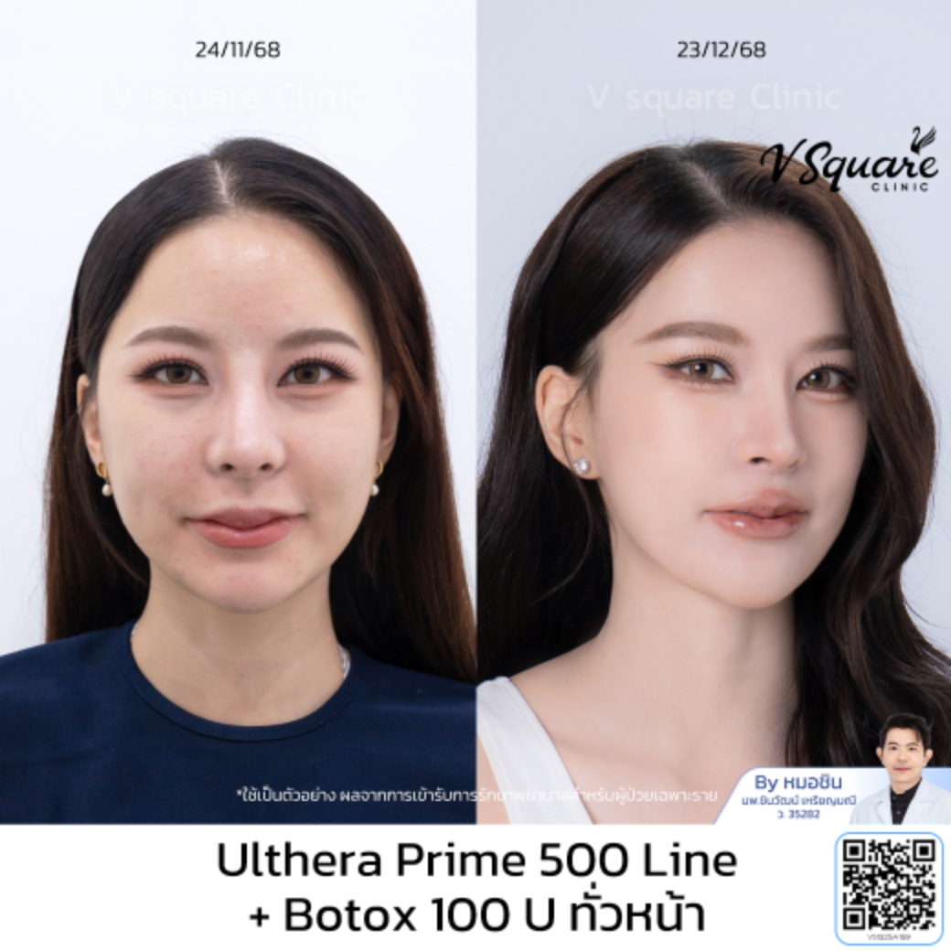 รีวิว Ulthera_คุณปุยนุ่น_โดยหมอชิน
