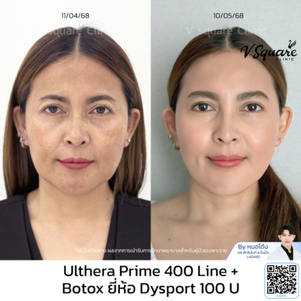 รีวิว Ulthera_น้าพลอย_โดยหมอโต้ง