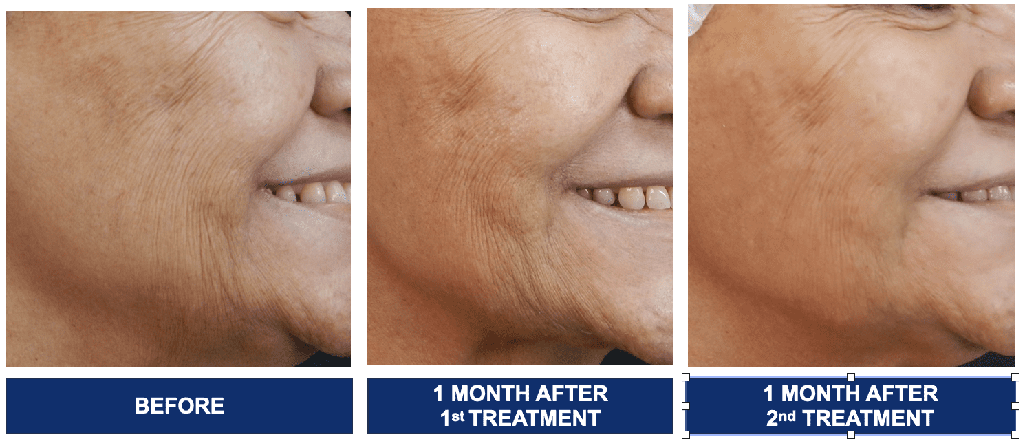 รีวิวผลลัพธ์ หลังฉีด Profhilo