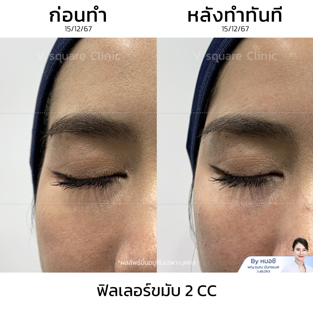 รีวิวฟิลเลอร์ขมับ