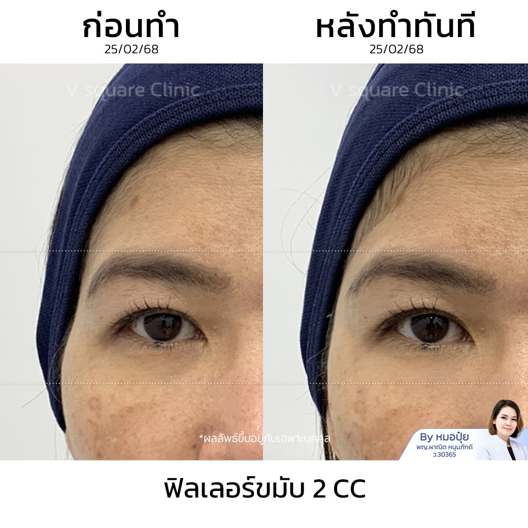 รีวิวฟิลเลอร์ขมับ