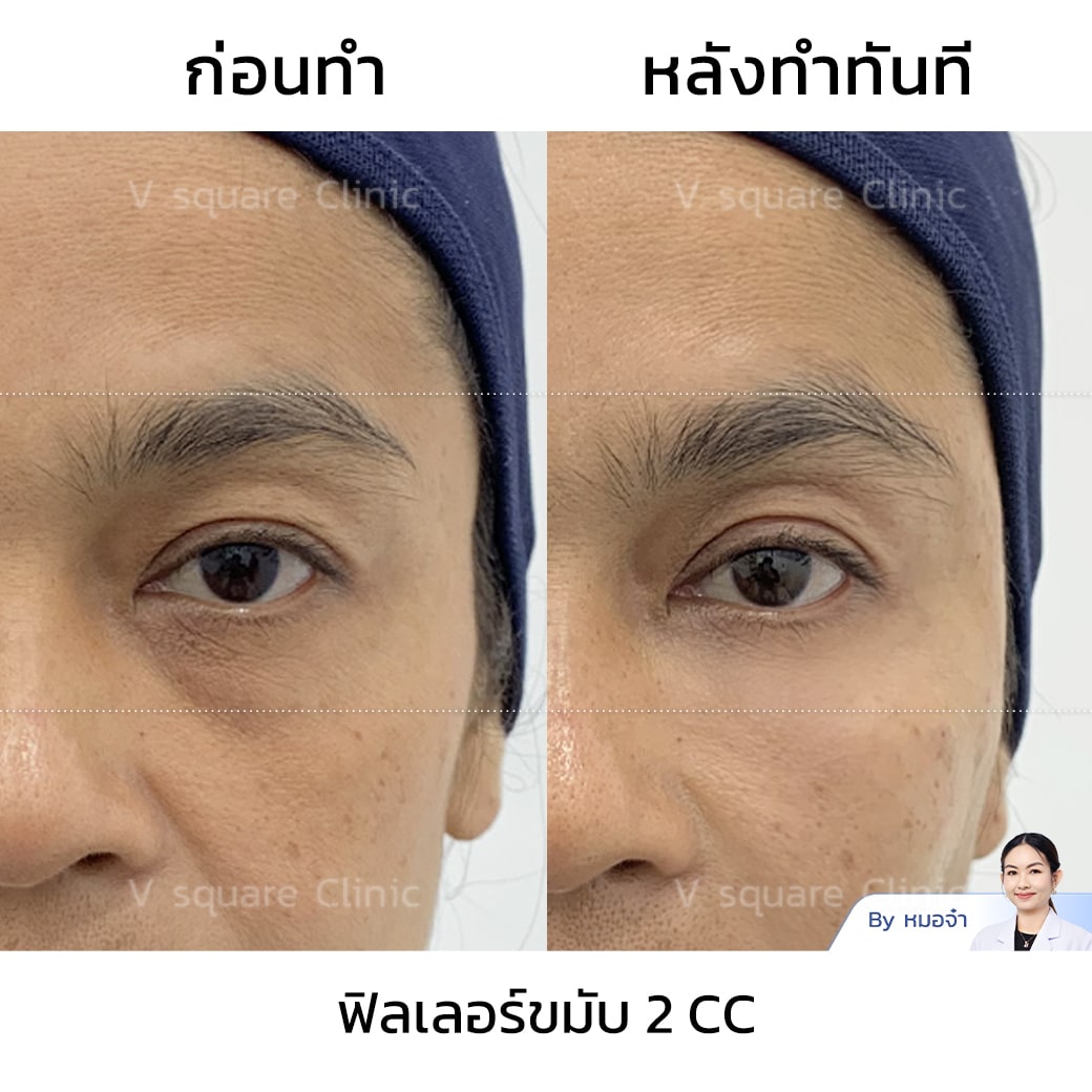 รีวิวฟิลเลอร์ขมับ
