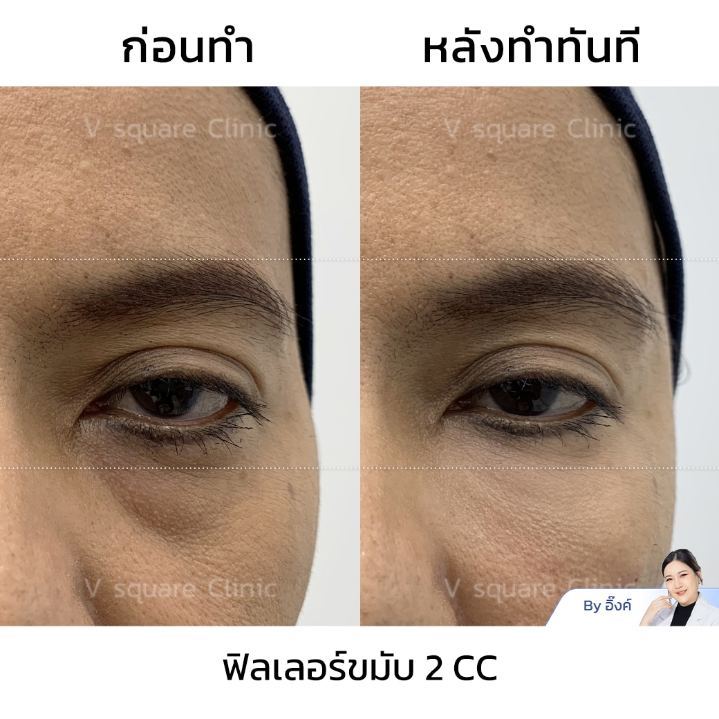 รีวิวฟิลเลอร์ขมับ