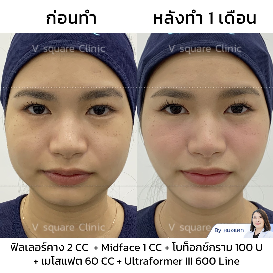 รีวิวฟิลเลอร์คาง
