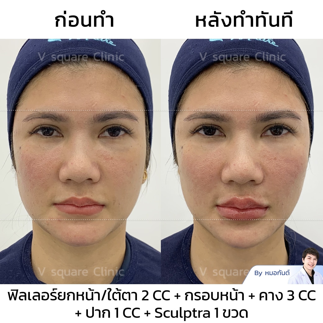 รีวิวฟิลเลอร์คาง